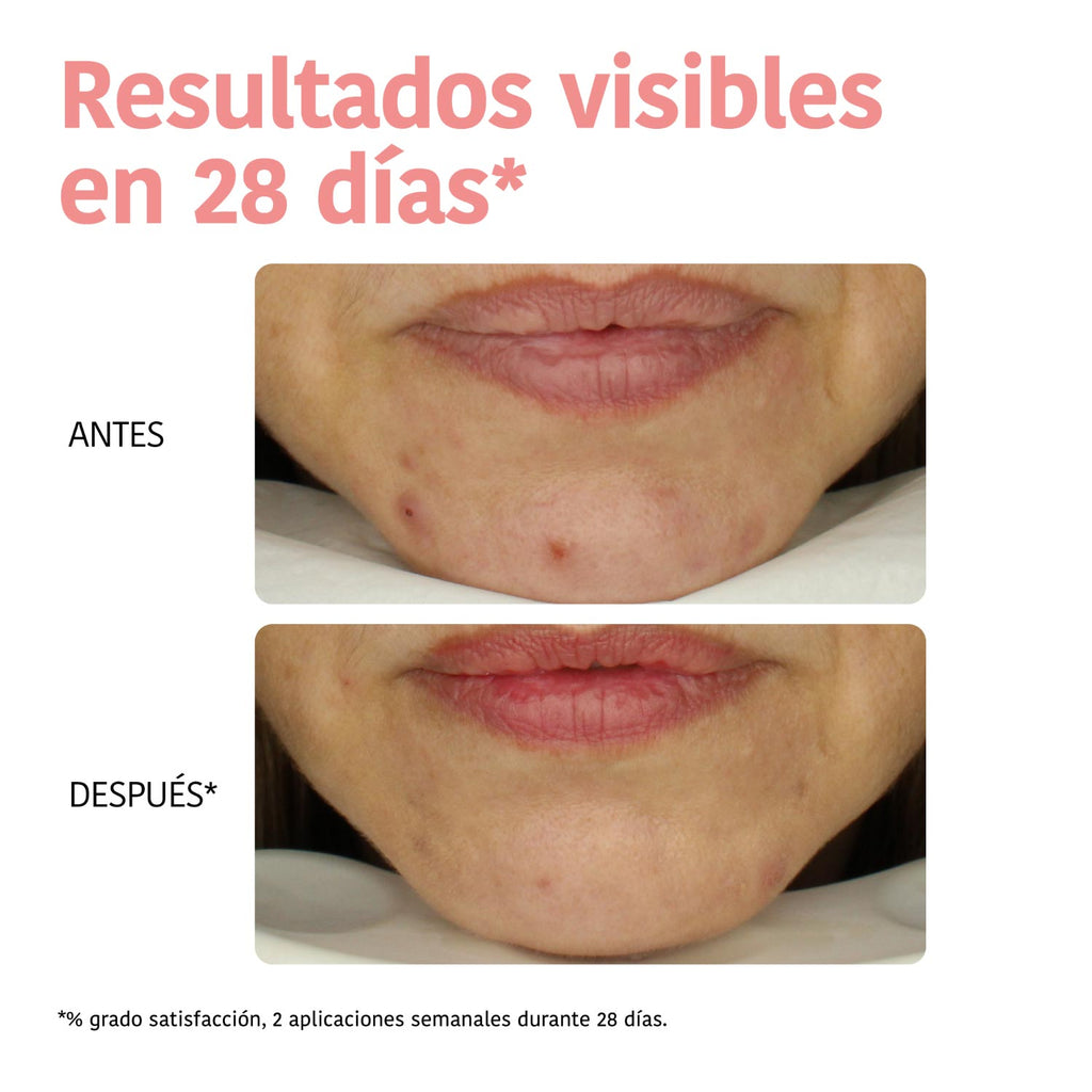 Mascarilla Peeling Exfoliante Ácido Salicílico
