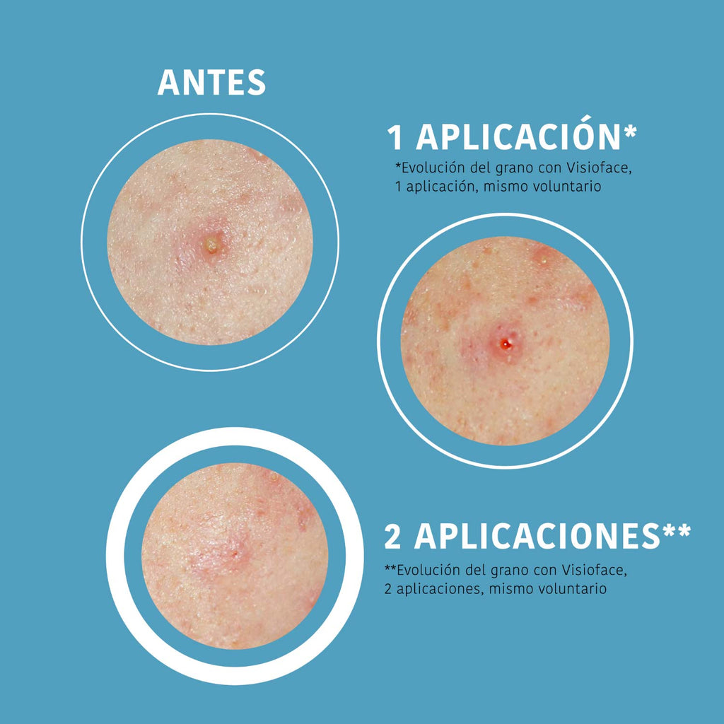 Parches SOS Granos Ácido Salicíico (18 Uds)