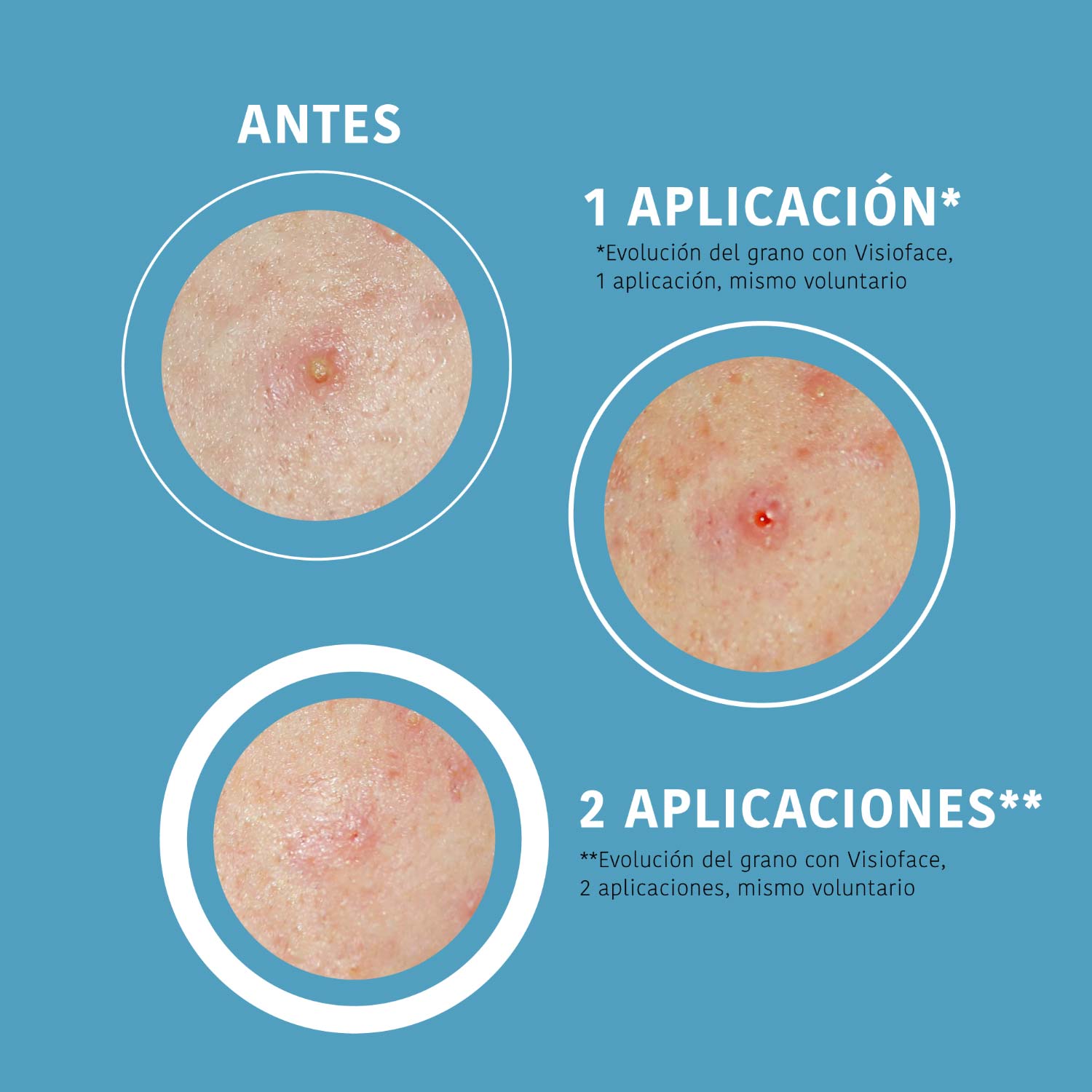 Parches SOS Granos Ácido Salicíico (18 Uds)